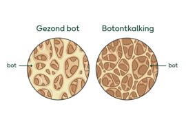 Tekening van hoe een gezond bot en botontkalking eruitziet.