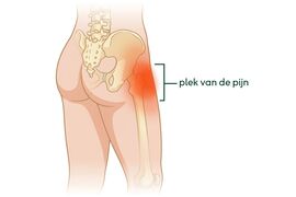 Tekening van waar de pijn zit aan de zijkant van je heup