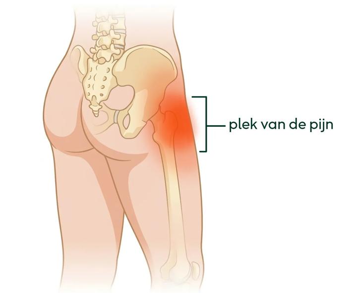 Tekening van waar de pijn zit aan de zijkant van je heup