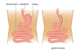 tekening van gastric sleeve