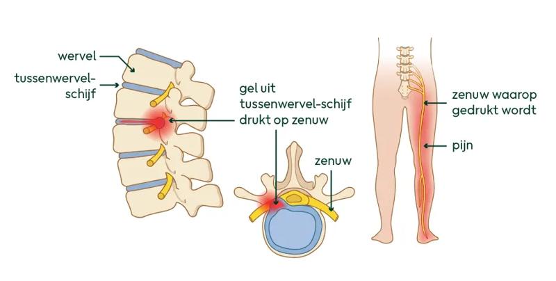 Tekening van de tussenwervel-schijf die op een zenuw drukt en pijn geeft.