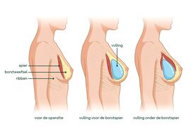 Tekening van de vullingen voor een borstvergroting