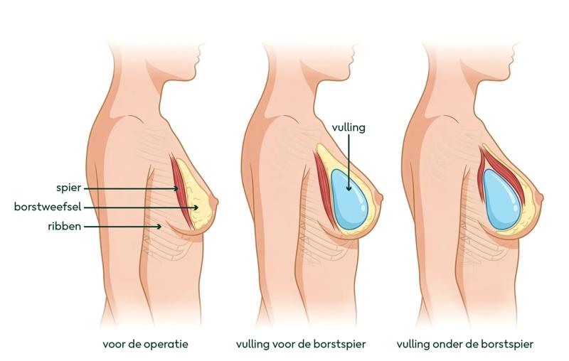 Tekening van de vullingen voor een borstvergroting