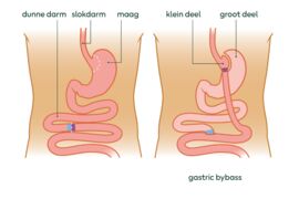 tekening van een gastric bypass