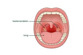 Tekening van een ontstoken keel en ontstoken amandelen. De keel is rood en de amandelen hebben witte en gelige plekjes.