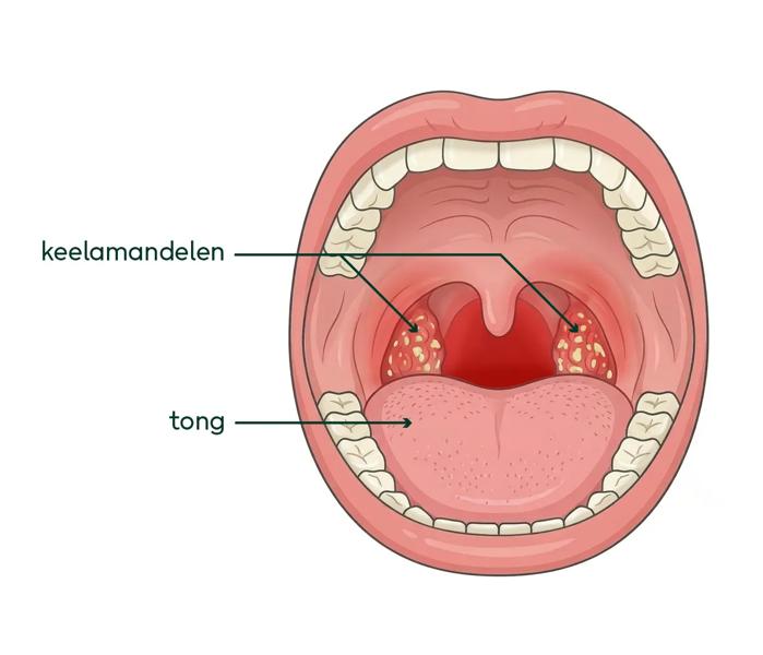 Tekening van een ontstoken keel en ontstoken amandelen. De keel is rood en de amandelen hebben witte en gelige plekjes.