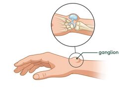 Tekening van een ganglion. Het vliesje om het gewricht of het buisje om een pees stulpt naar buiten.